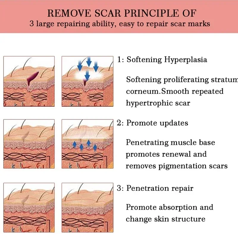 Scar Removal Herbal Cream Repair Stretch Marks Treatment Gel Burn Acne Surgical Acne Scar Ointment Whitening Beauty Health Care