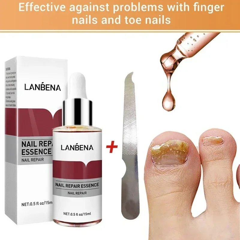 

Fungal Nail Repair Essence Serum Care Finger Toe Anti Nail Repair Footcare Fungal Nail Treatment Liquid