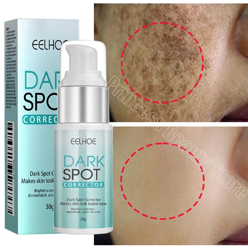 Whitening Body Cream Effective Whitening Freckle Cream Remove Dark Spot Lotion Removal Melanin Melasma Lighten Brighten Anti-Aging Skin Care Products,facial cream