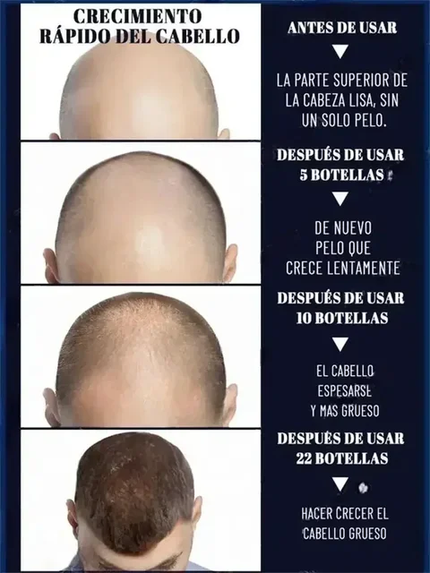 Hot selling product, 99% of buyers buy again, have more and more hair, say goodbye to baldness, thick hair - Image 6