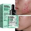 Acne Removal Whitening Serum Effective Fade Acne Spots Repair Product Control Moisturizing Shrink Pores Acne Treatment Skin Care