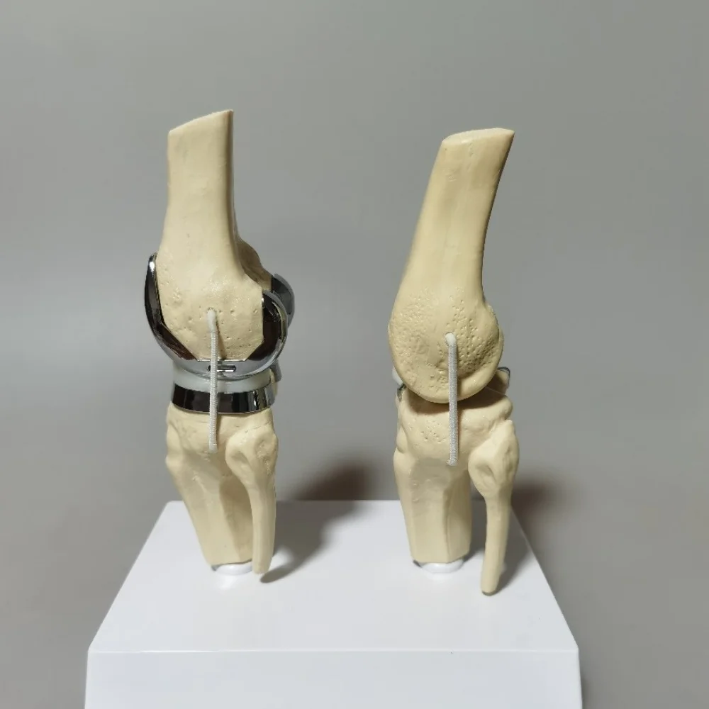 Detachable Artificial Knee Prosthesis Model Small Double Silver Knee Joint Implant Model Set
