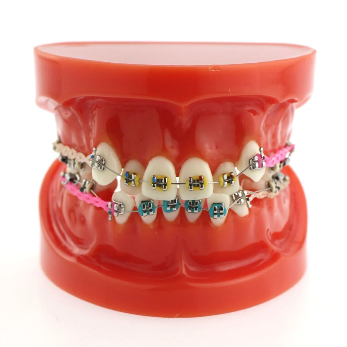 dental-orthodontic-treatment-teeth-model-malocclusion-correction-with-metal-brackets-teaching-model-for-patient-demo