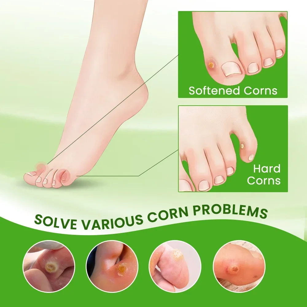 Description Picture 3 of itemFoot Corn Remover Cream Chicken Eye Skin Infection Treatment Ointment Feet Dead Skin Calluses Removal Tool Health Care