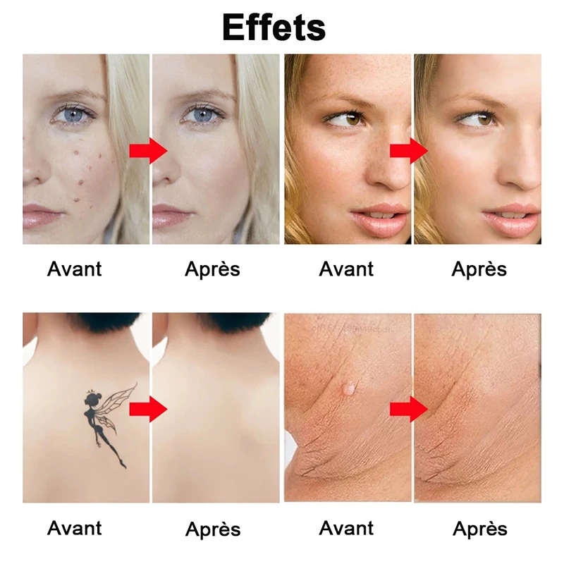 Creion laser cu picosecunde, îndepărtarea acneei, nevus, pete negre, pigment pentru tatuaje, hine_voghion.com
