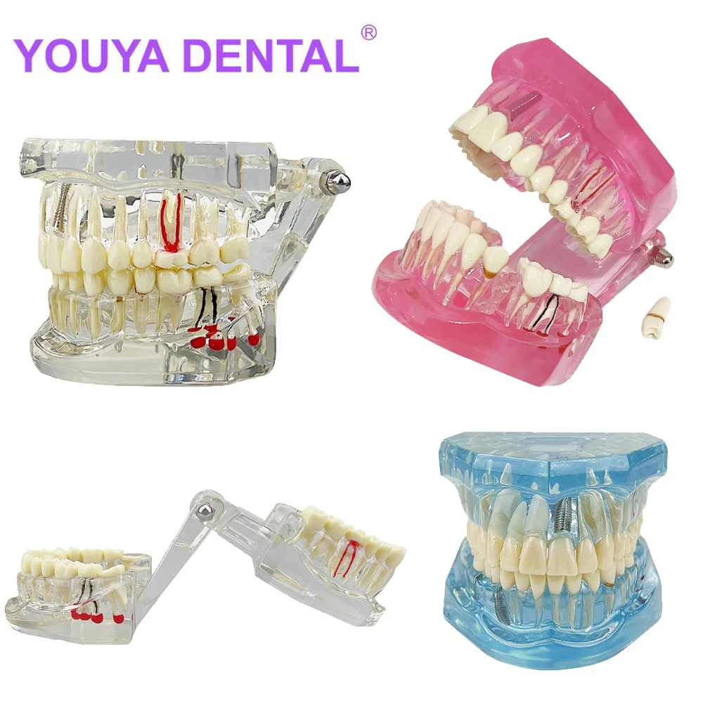 Dental Restoration & Disease Analysis Teaching Model