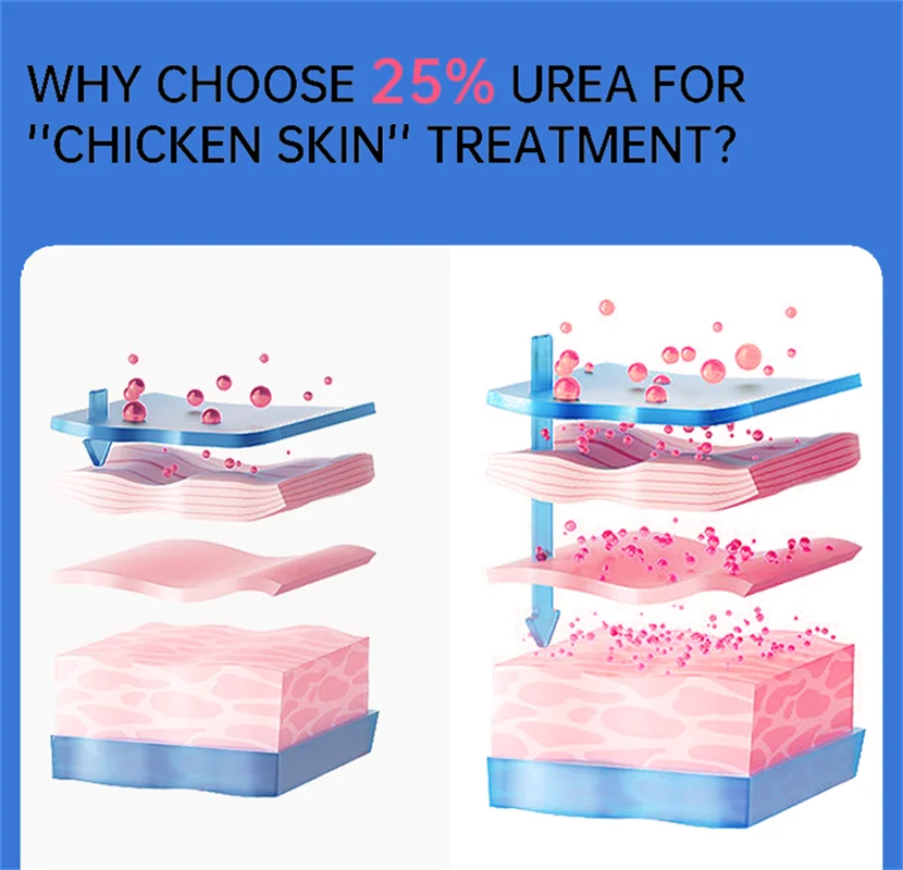 New Chicken Skin Repair Cream Curing Keratosis Follicle Pilaris Remove Thick Pores Body Dark Spot Moisturize Smooth Skin Care 5