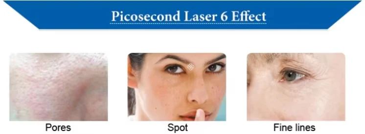 Picosure Laser Tattoo Removal Machine For Sale 10 <h3 class="features--headline">Features and benefits</h3> Safe and effective - non-invasive, high efficiency, minimal side effects Quick Treatment - process is quick,without significant downtime. Tattoo Removal - Effective for all skin types removes all ink colors Other skin treatment - Pigmentation correction, Skin rejuvenation, skin revitalization, acne scar removal <hr /> <h5></h5> <h5><span class="tw-text-2xl tw-font-bold" style="color: #99ccff;">IN STOCK READY TO SHIP</span></h5> <h5><span class="tw-text-2xl tw-font-bold" style="color: #99ccff;">1 YEAR WARRANTY + 3 YEAR TECH SUPPORT</span></h5> <h5><span class="tw-text-2xl tw-font-bold" style="color: #99ccff;">30 DAY MONEY-BACK AND <a href="https://salonmachines.com/refund_returns/">RETURN POLICY</a></span></h5> <h5><span class="tw-text-2xl tw-font-bold" style="color: #99ccff;">FREE WORLDWIDE SHIPPING <a href="https://salonmachines.com/shipping-policy/">SHIPPING POLICY</a> </span></h5> <h5><span class="tw-text-2xl tw-font-bold" style="color: #99ccff;">PROFESSIONAL BEAUTY <a href="https://salonmachines.com/">SALON MACHINES</a> EQUIPMENT</span></h5> <div class="product-block product-block--sales-point"></div> Picosure Laser Tattoo Removal Machine For Sale
