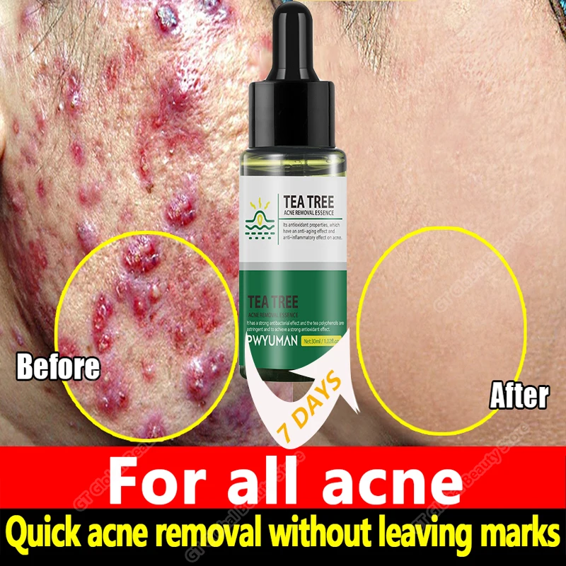 

Tea Tree Acne Removal Serum Effective Oil Control Acne Treatment Repair Acne Mark Moisturizing Shrink Pore Skin Care Products