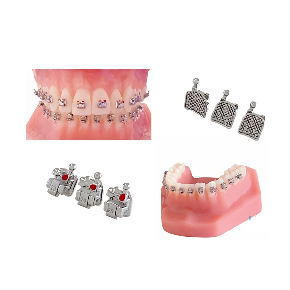 Рисунок 5 - KND ортодонтический металлический