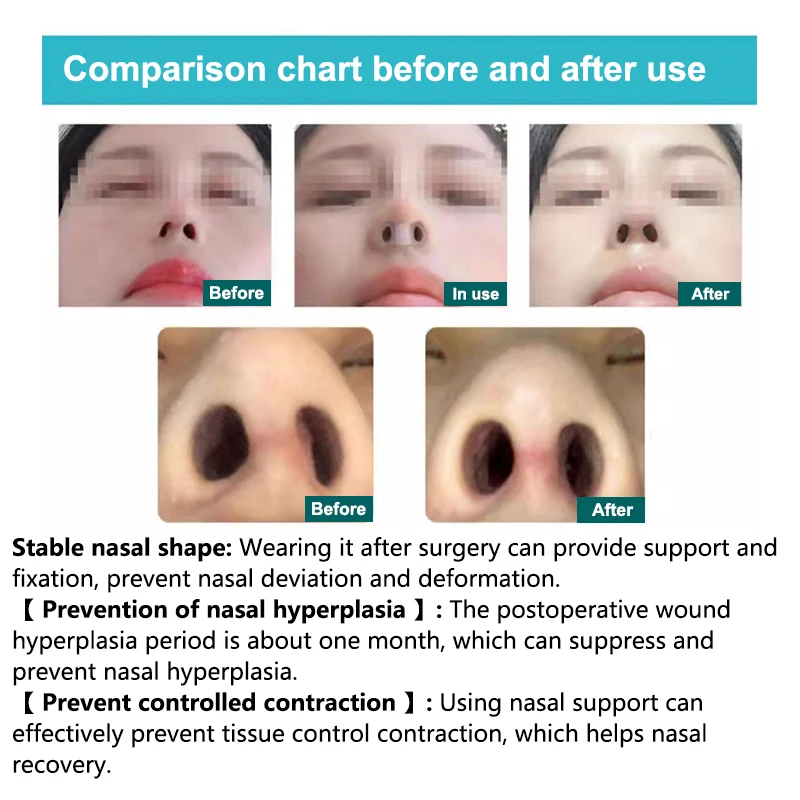 Rhinoplasty Nostril Support Postoperative Silicone Shaping Mold Crooked Nose Correction Fixator Nasal Wing Beauty Noseclip 1pc nose clip,nose shaper,nostril opener dilators