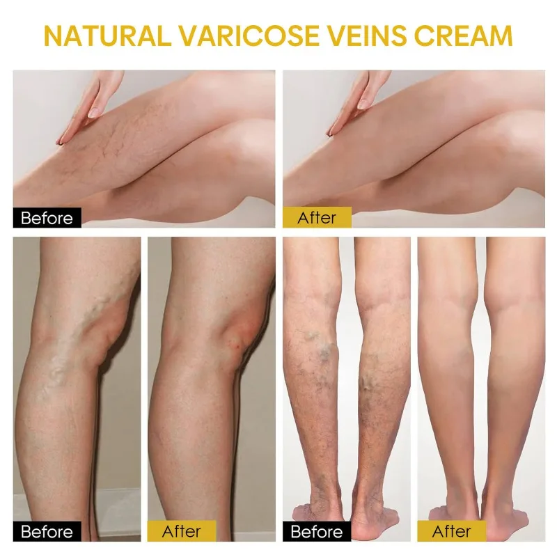 발톱무좀 Bee Venom Venous Repair Cream Relieves Leg Pain and Swelling Smoothes Vascular Protruding Veins Personal Health Care personal health care