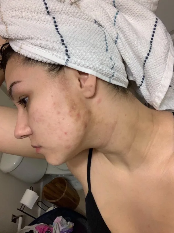AUQUEST Salicylic Acid Acne Face Cream photo review