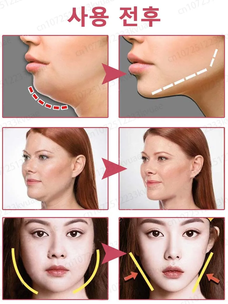   ũ Ÿ    , Oedema  Ʈ ŸƮ, V   , ڿ ,  