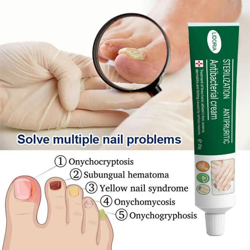 Herbal Foot Fungus Removal Cream Nail Care Ointment Anti Fungal Infection Onychomycosis Paronychia Toe Fungus Repair