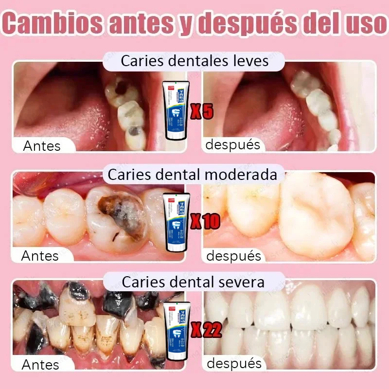 Quick Repair Cavities Caries Probiotic Toothpaste Clean Whiten Remove Yellow Plaque Protect Gum Reduce Tooth Stains Fresh Breath