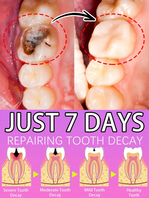 Solve teeth decay problem