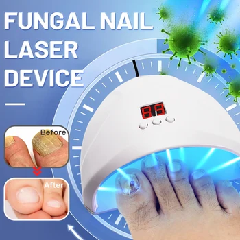 Fungal Nail Laser Device 1