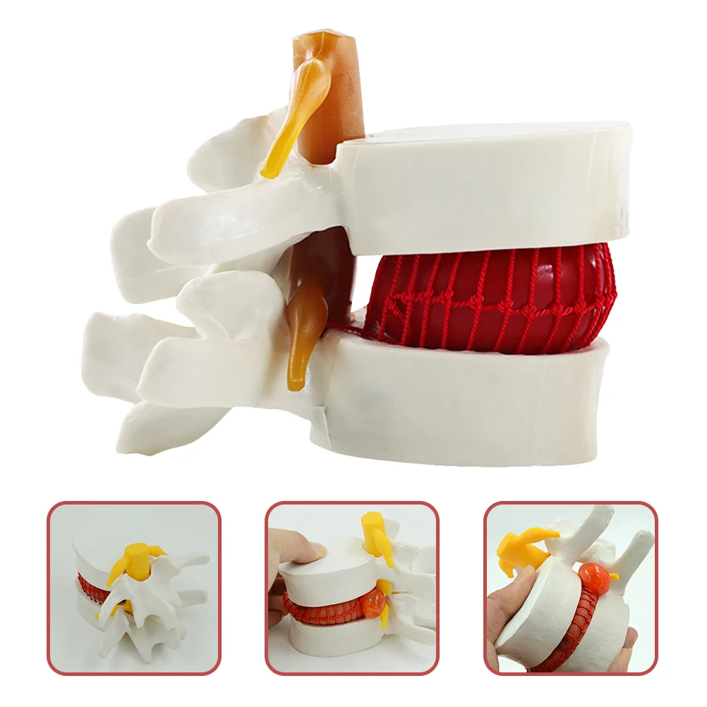 

Intervertebral Disc Model Lumbar Vertebrae Degenerative Human Spine Mannequins Anatomical Herniation Demonstrating