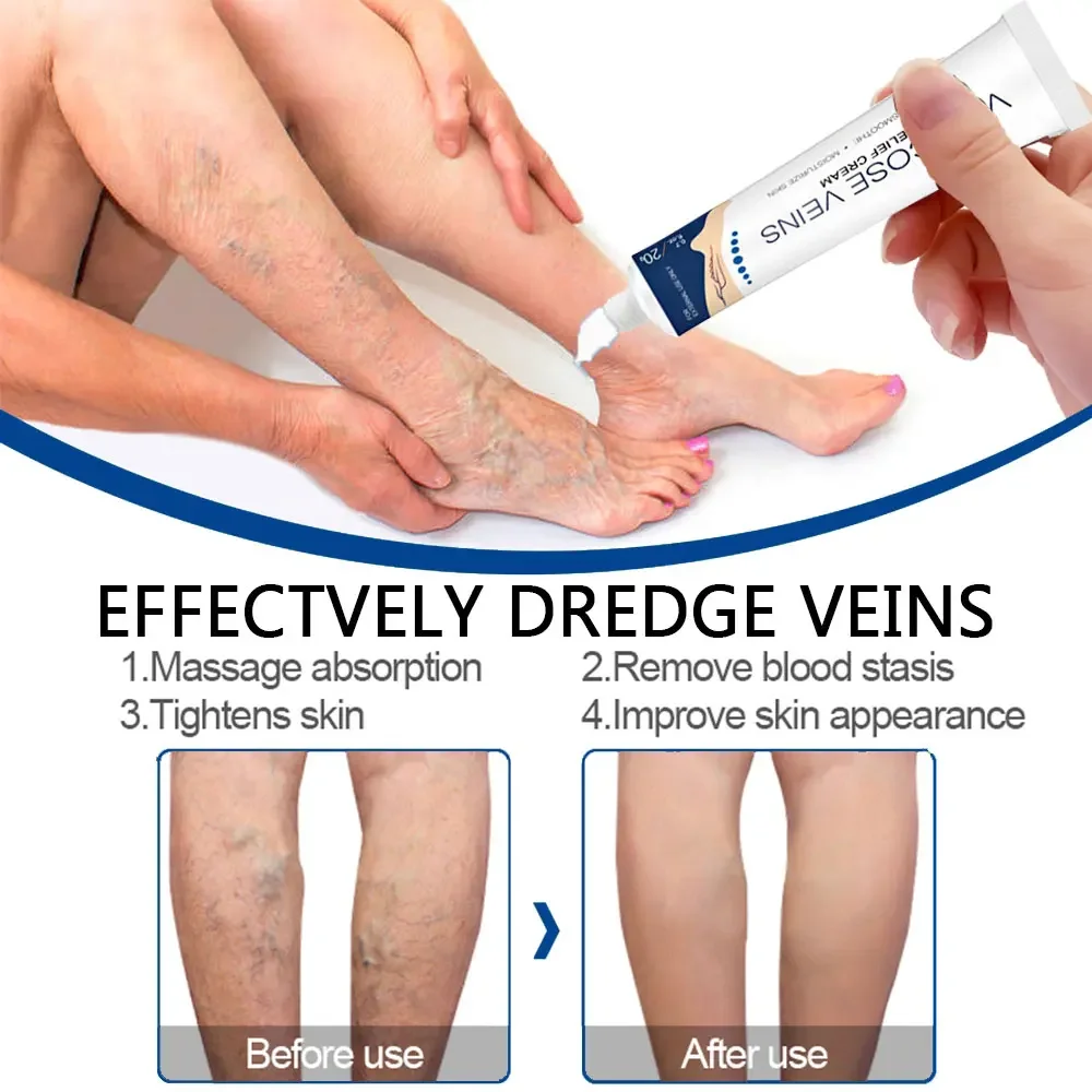 Jemeesen Effective Varicose Veins Cream Relieve Vasculitis Phlebitis Spider Pain Relief Ointment Herb Plaster Beauty Body Care
