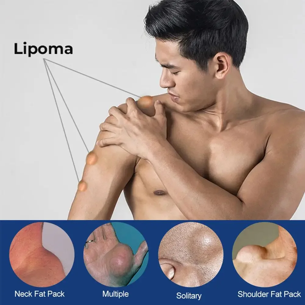 Lipoma Removal Cream Effective Antitumor Remove Fat Lump Ointment Herbal Extracts Nodular Skin Cyst Swelling Painless Treatment pain relief cream,skin care ointment,knee pain relief cream,hemorrhoids treatment cream,antibacterial anti fungal cream,sex delay cream