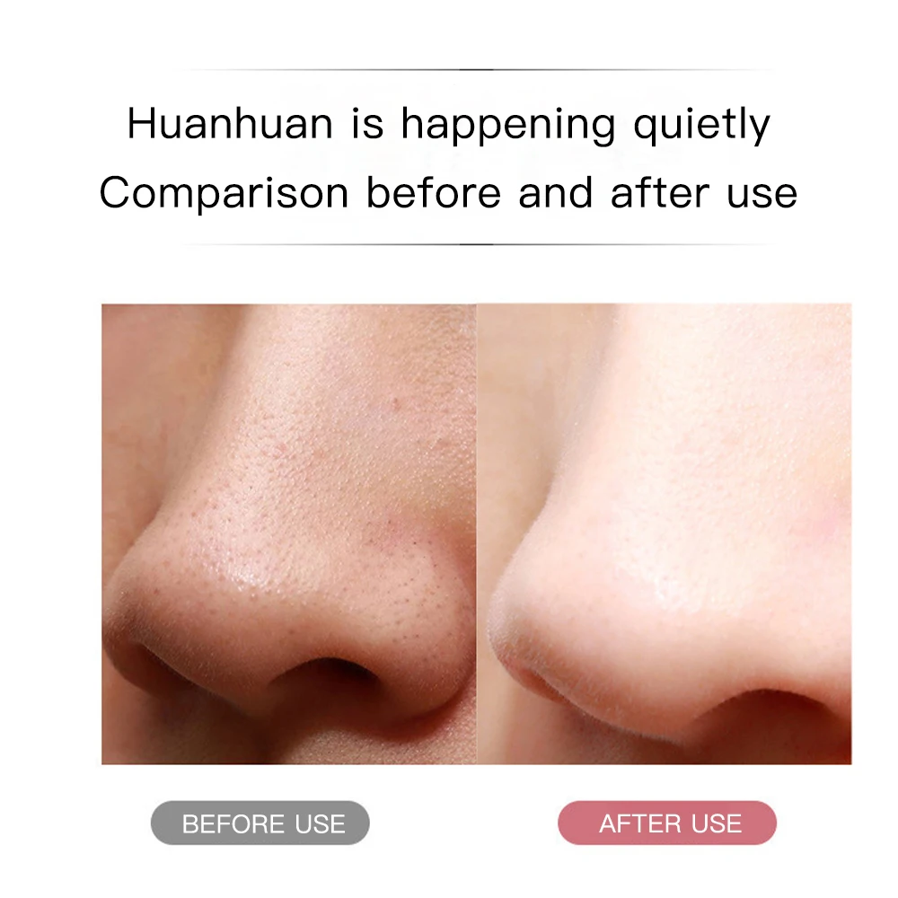 Remove Blackhead Skin Scrubber Ance Pore Cleaner Peeling Blackhead Remover Deep Face Cleaning Ion Facial Shovel Cleanser