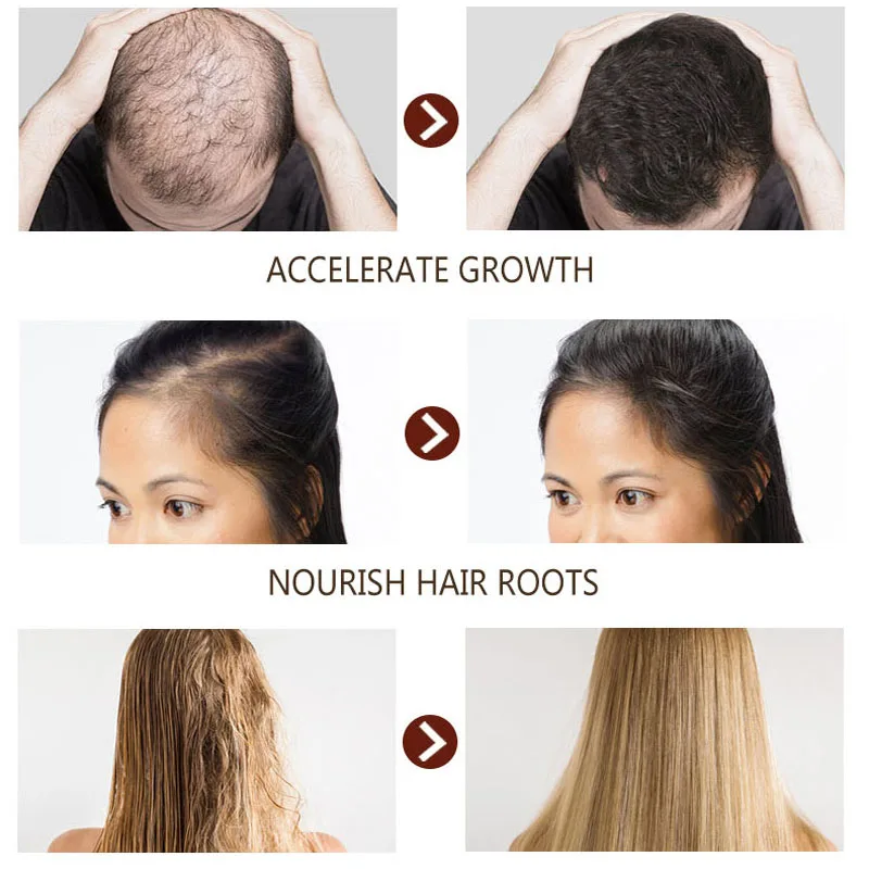 Disaar 30ml Fast Hair Growth Essential Oil Ginger Formula Anti-hair Loss Oil Head Scalp Treatment For Men And Women