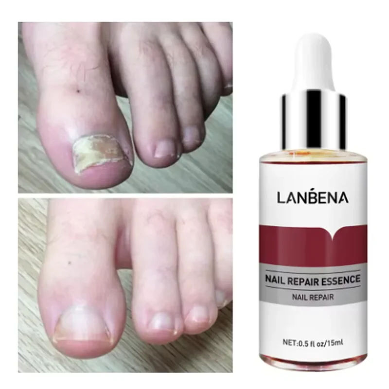 15mlFungus Care Remove Onychomycosis Toes Nourish Brighten Hands Feet Product Repair Suitable Women Nail Pepair Essencs