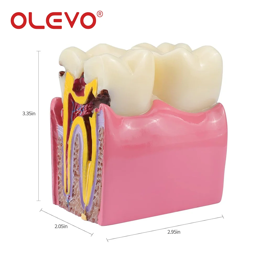 OLEVO 치과 교육 치아 모델 6 배 우식 비교 데모 학생 공부 치과 실험실 훈련 틀니 모델