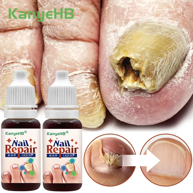 

2Pcs Foot Nail Fungus Feet Treatment Liquid Nail Fungus Removal Herbal Medicine Liquid Anti Infection Fungal Nail Care A1500