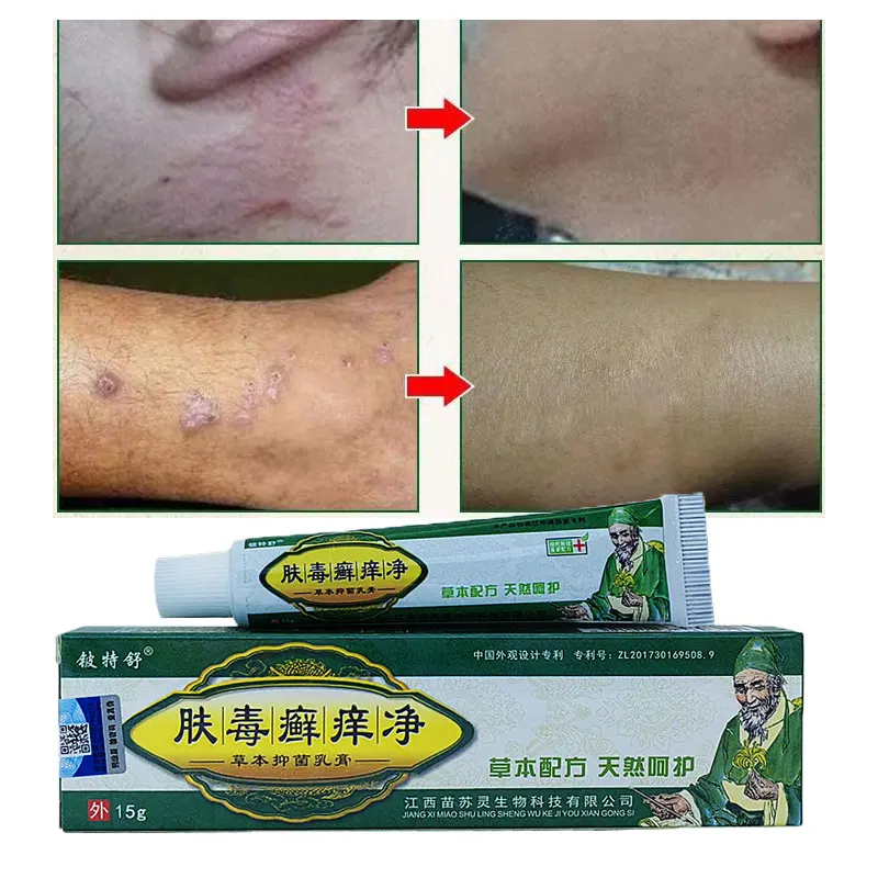Psoriasis Ointment Dermatitis Anti Fungal Infection Skin Dermatitis