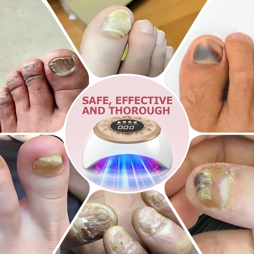 Nail Fungus Laser Treatment Device Repair Toenail Fingernail Fungus Treat Onychomycosis Laser Nails With Mushrooms Remove nail fungus remover laser therapy pen