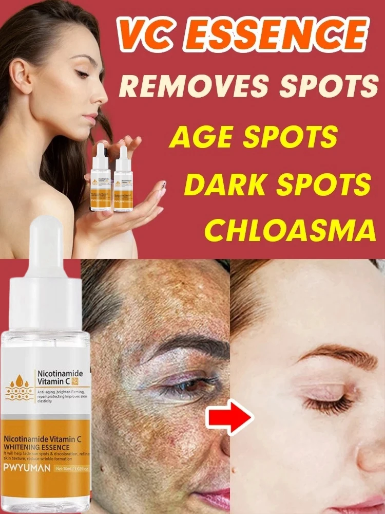 Niacinamide Whitening Spot Serum Vitamin C Powerful Removal Black Dot Melasma Chloasma Age Spots Moisturizing Skin Care Products dark knuckle whitening serum get rid of dark knuckles removal oil dark spots pigmentation correctors for black skin elbow knee