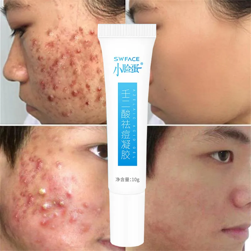 Azelaic Acid Stock Solution Remove Acnes Pimples Dark Spot Scars Anti