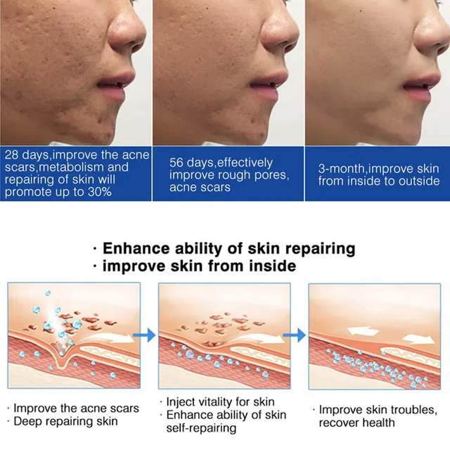 Pattanás Kezelés A Szérum 100% Egf Tiszta Természetes Esszencia Hatékonysága Súlyos Pattanások Eltávolító Pattogó Javítás Bőrfehérítés - Image 3