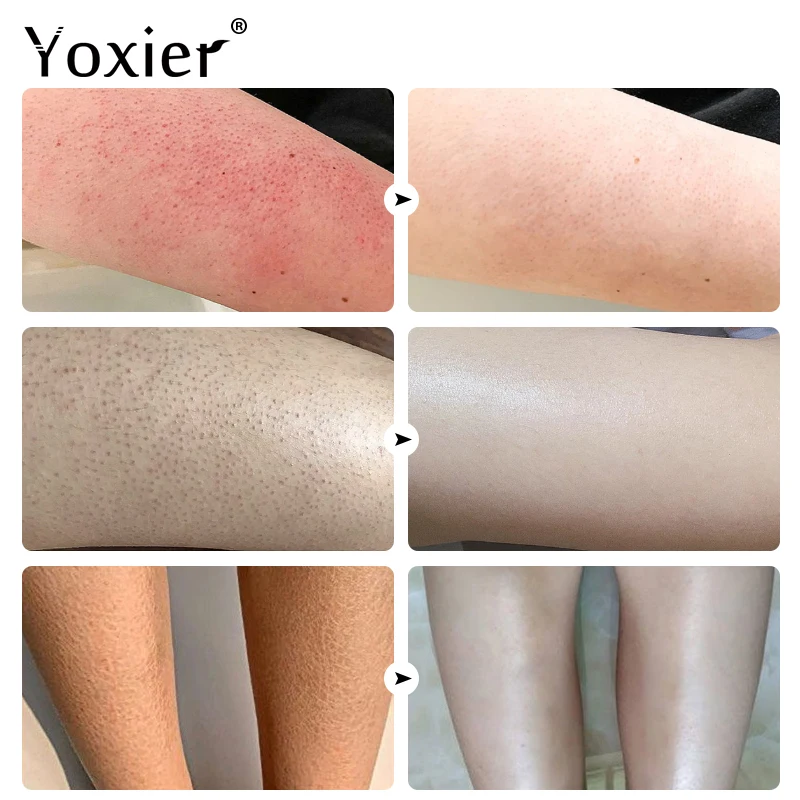 Keratosis Pilaris Repair Cream Vitamin E Skin Care Moisturizing Remove Hard Lumps Dry Rough Adjust Skin Tone Tighten Skin 50g 3