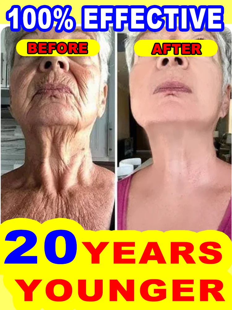 wrinkles disappear，20 years younger 2