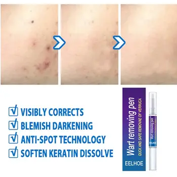 Wart Removal Mole Remedy Liquid Pen Treatment Papillomas Removing Skin Labels Flat Wart Genitals Painless Beauty Herbal Cream 4