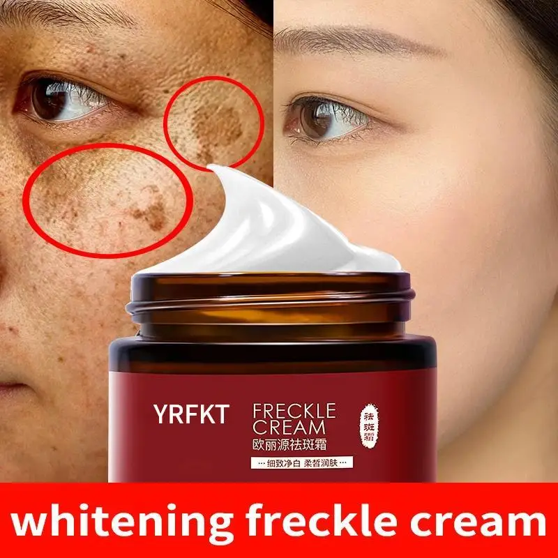 Whitening Freckle Cream Remove Melasma Spot Acne Pigment Melanin Dark Spots Pigmentation Freckle Removal Cream 