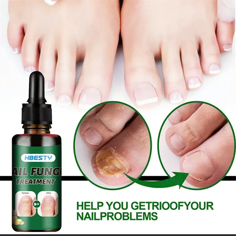 7Days Nail Fungus Treatment Serum Ginger Anti-infective Paronychia Onychomycosis Toe Foot Nail Fungal Repair Gel Hand Foot Care nail fungus treatment