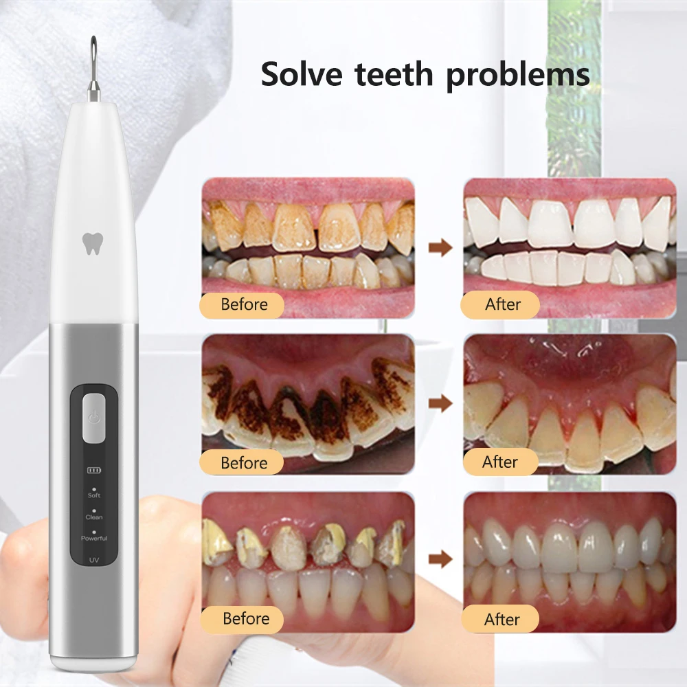 Ultrasone Tandheelkundige Scaler Voor Tanden Tandsteenvlek Tand Tandsteenverwijderaar Elektrische Sonische Tandplak Reiniger Calculus Verwijderen