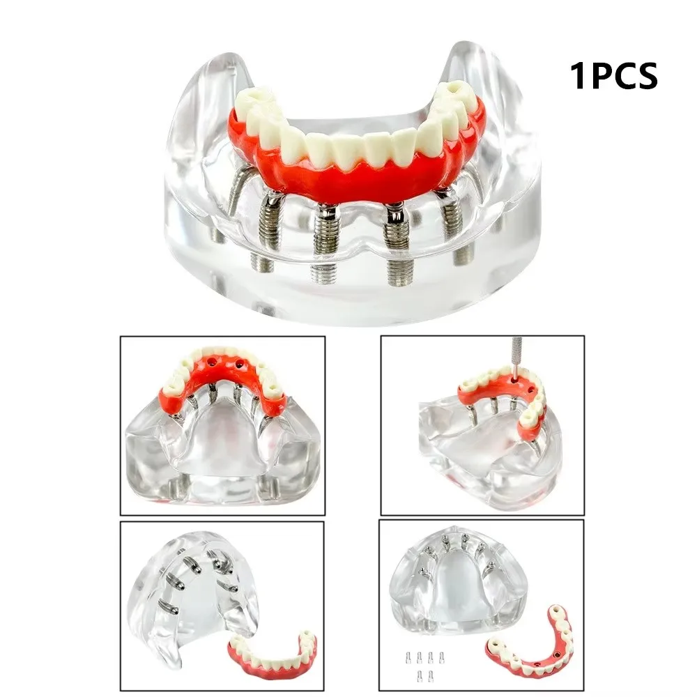 AWJ Modello di Denti per impianto Dentale 4 Volte, analisi dell'impianto Crown Bridge Dimostrazione Modello di Denti, Denti dentali Radici della Corona Rimovibili per l'istruzione, la comunicazi