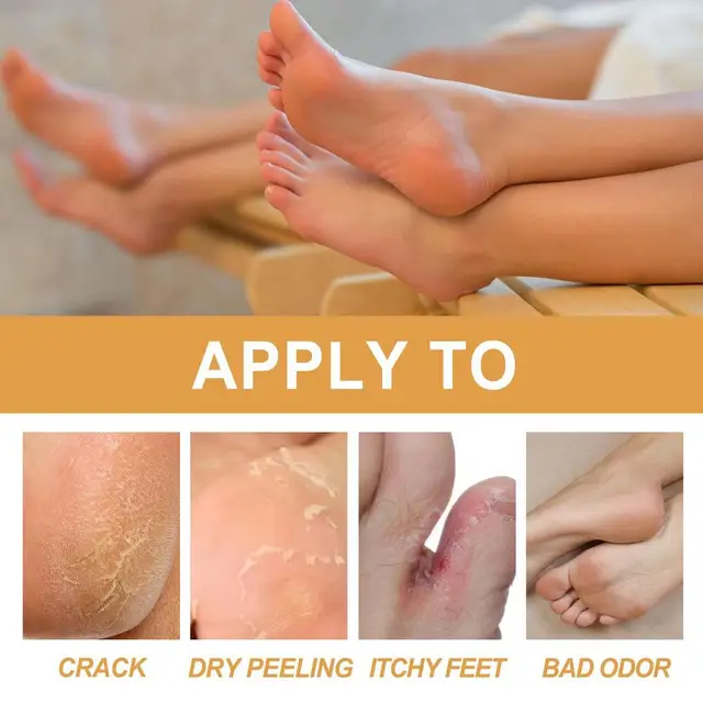 Foot Callus Removal Spray 1.01 Oz Dry Feet Skin Remover Foot Care Callus  Softener For Exfoliation Hydrating Quickly Nourish Feet - AliExpress