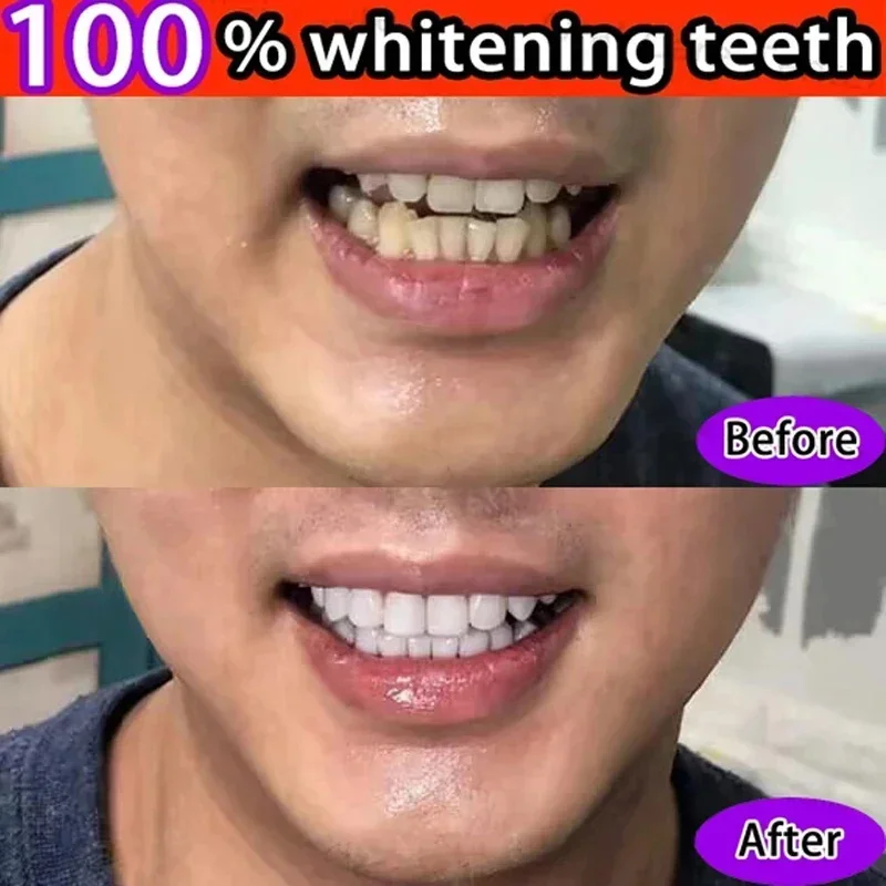 Dental Calculus Remover Teeth Whitening Toothpaste Oral Hygiene Cleaning Remove Plaque Stains Prevent Periodontitis Fresh Breath