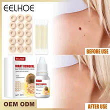 

Eelhoe Anti-Warts Antibacterial Liquid Skin Tag Remover Genital Wart Treatment Removal Mole Papillomas Bacteriostatic Liquid