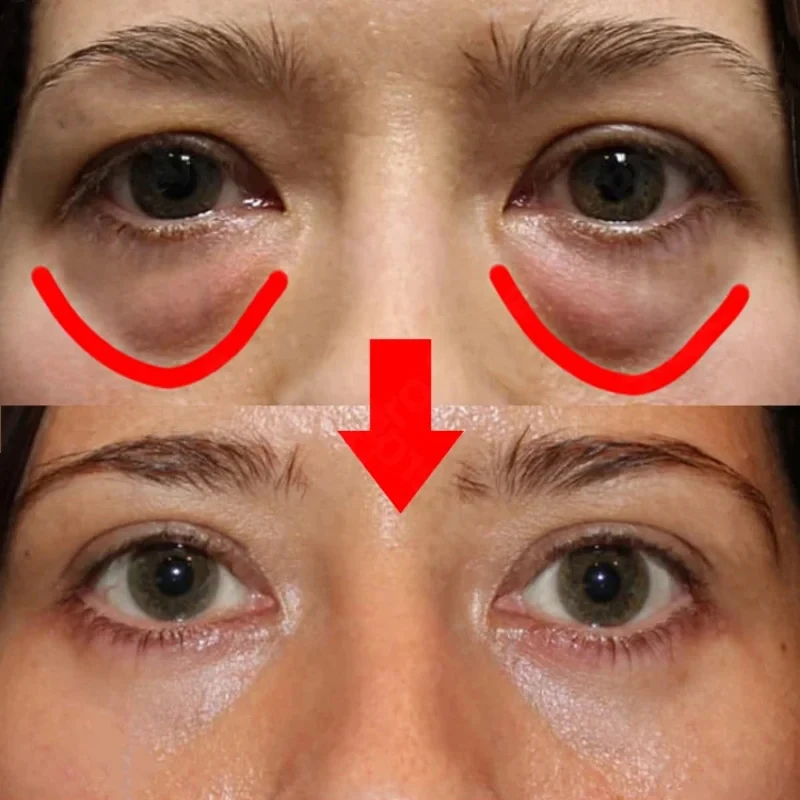 Collagen Eye Mask Eyes Bag Remove Instant Fade Fine Lines Dark Circles Fat Particles Moisturizing Anti-Puffiness Korea Eye Care