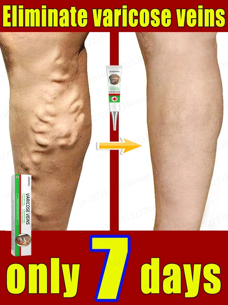 

Varicose vein ointment, repair varicose veins and vasculitis in 7 days