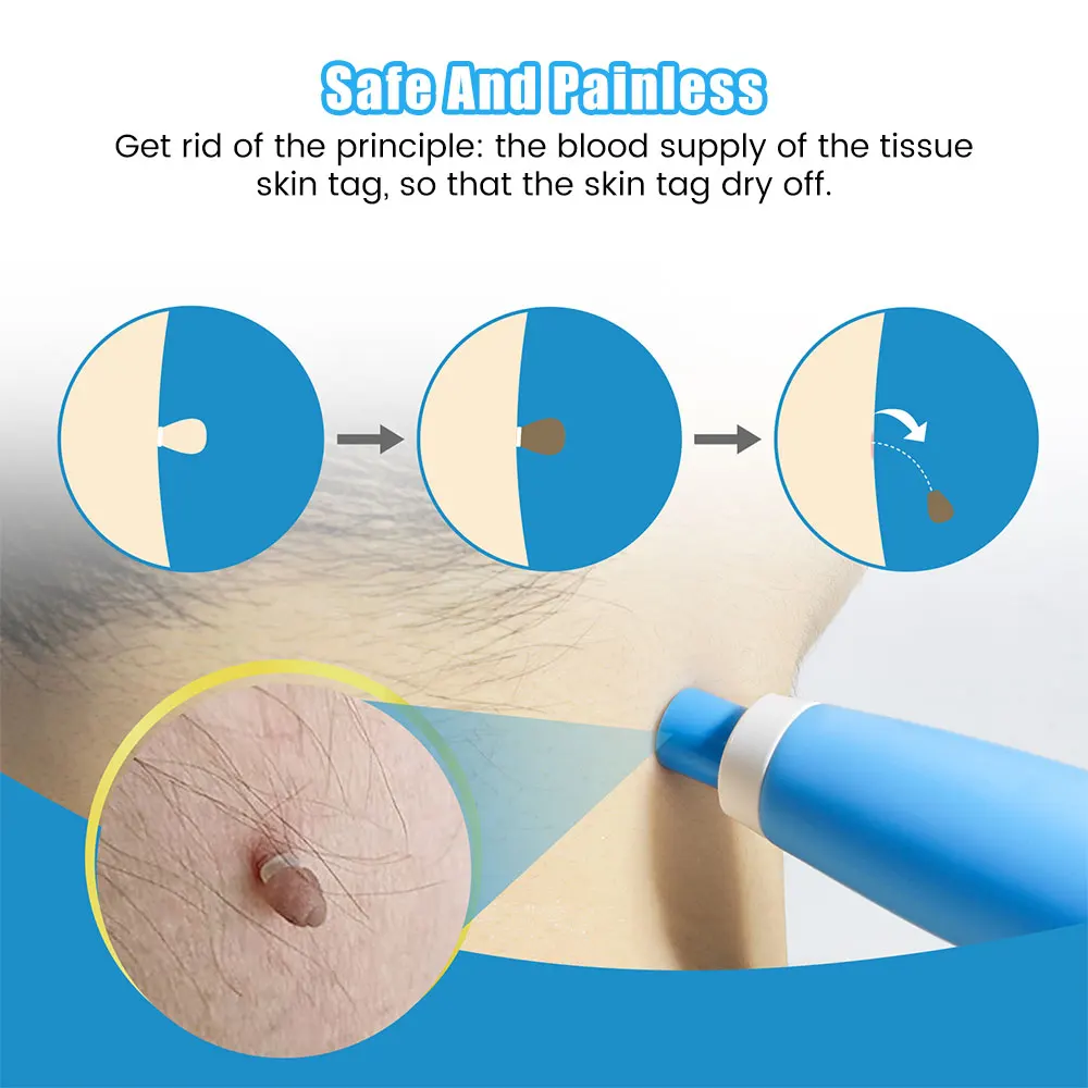 2 In1 Skin Tag Mole Wart Removal Kit Cleaning Tools Skin Care Wart Treatments Remover