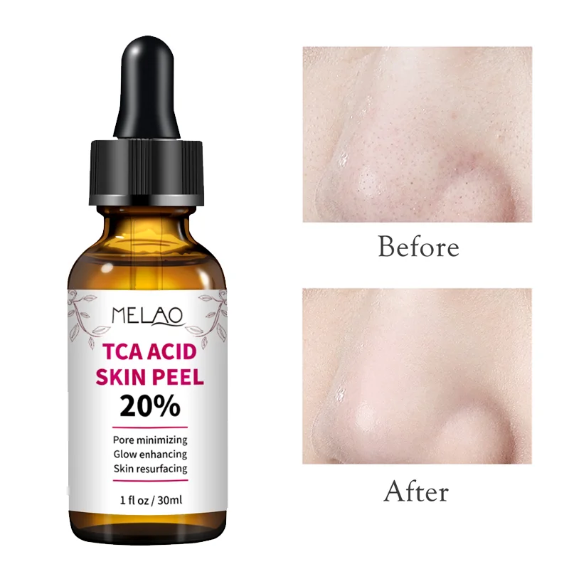 30ml skórki kwas trichlorooctowy roztwór TCA pielęgnacja skóry wybielanie chemiczne wybielanie Serum 20% Melao TCA kwas skóry Teel 1Pc