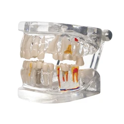 Dental Implant Disease Demonstration Model - Transparent Teeth for Oral Pathology Research and Teaching (Teeth model)